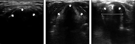 Ultrasound images of the airway. (A) Image at the hyoid bone level. The... | Download Scientific ...