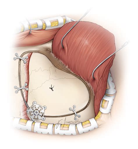 Pterional Craniotomy | The Neurosurgical Atlas