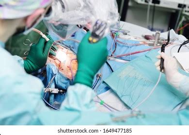 Neurosurgeons Perform Surgery Excise Brain Tumor Stock Photo 1649477185 ...