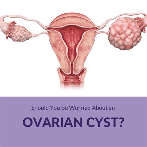 Should You Be Worried About an Ovarian Cyst? - Sunshine State Women's ...