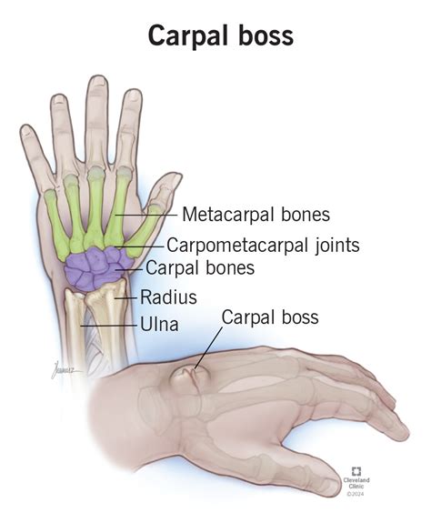 Carpal Boss: What Is It, Causes, Symptoms & Treatment