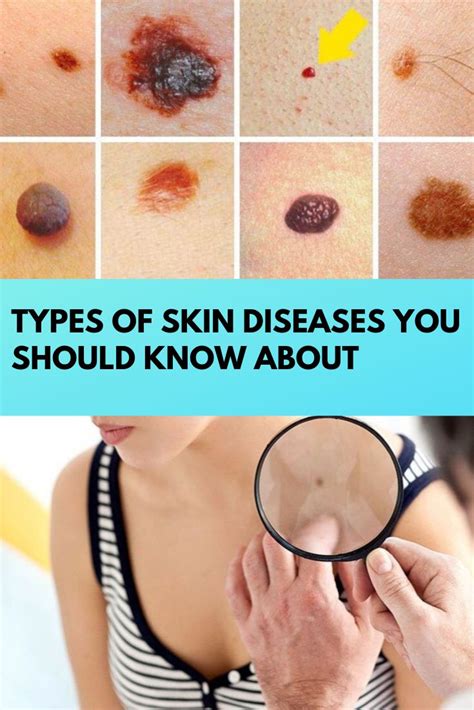 Types of skin diseases you should know about | Skin diseases, Health, Disease