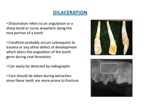 Development of tooth