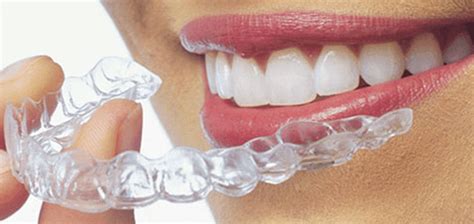 Aligners - Mega Dental Care | Braces | ImplantsCrowns - Fixed | Root Canal therapy