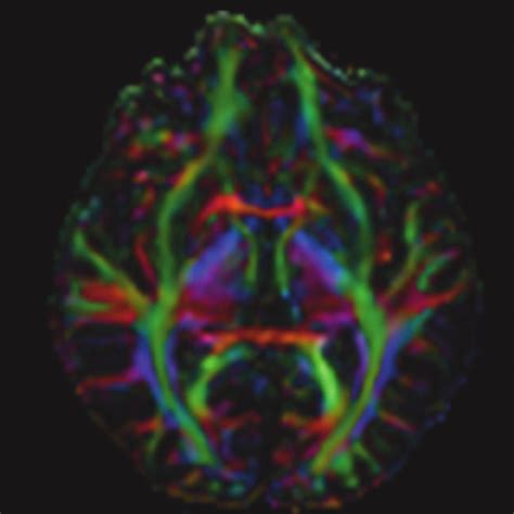 Fractional anisotropy (FA) maps displayed as color-orientation maps.... | Download Scientific ...