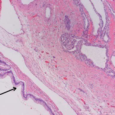 Histological slide demonstrating synchronous IPMN and serous... | Download Scientific Diagram