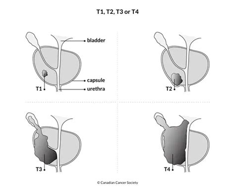 Stages of prostate cancer | Canadian Cancer Society