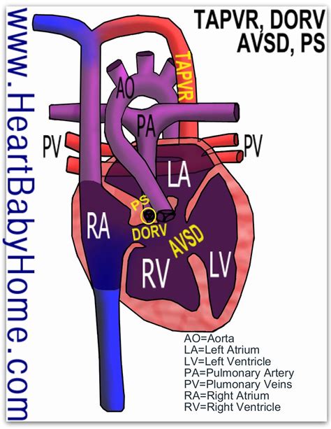 Heterotaxy, TAPVR, DORV, AVSD | Heart defect: heterotaxy, ri… | Flickr