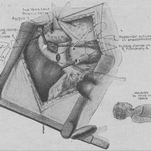 Graphic explanation of the BTT shunt, appeared in the first joint paper... | Download Scientific ...