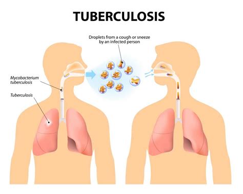 Do you know TB’s causes and symptoms to keep your family safe? - Dr Lal PathLabs Blog