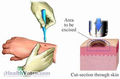 Best Cost Skin Biopsy Surgery, Treatment Hospital in India