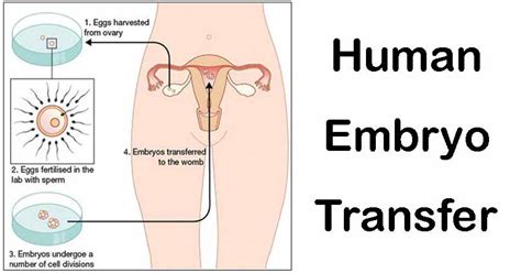 Human Embryo Transfer- Conditions, Types, Procedure