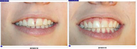 Before and After Same Day Resin composites to close diastema – McFarlane Dental