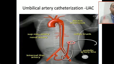 Umbilical Artery Catheter Anatomy | Images and Photos finder