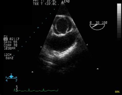 Andrew R. Houghton: Ten key facts about bicuspid aortic valve disease