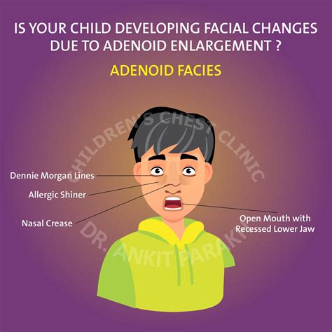 Is your child developing facial changes due to an enlarged adenoid? - Dr. Ankit Parakh