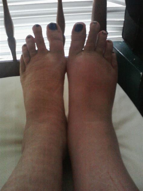 Lymphedema Treatment