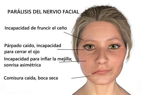 Tipos De Par Lisis Facial Perif Rica Y Central Paralisis Facial | The Best Porn Website