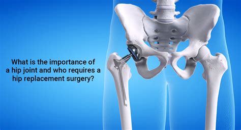 What is the importance of a hip joint and who requires hip replacement surgery? : Eternal Hospital