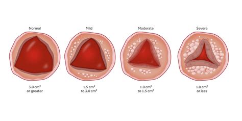 Listening for the warning sounds of aortic stenosis • The Medical Republic