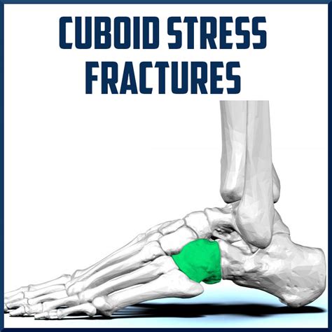 Cuboid Fracture Healing