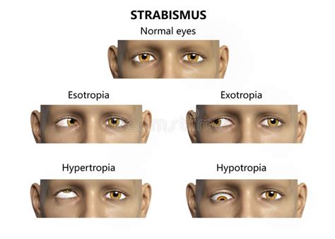 Strabismus, Eyes Deviation, Illustration Stock Illustration ...