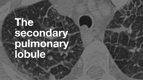 The Secondary Pulmonary Lobule - YouTube