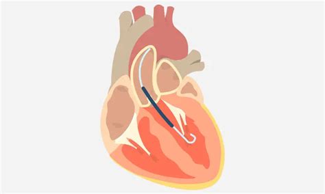 Get to Know the Impella Heart Pump and How it Works