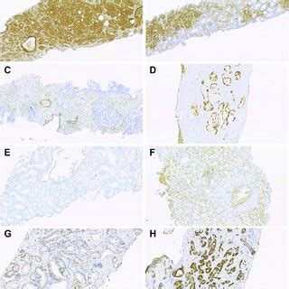 Staining patterns of IHC markers scored as continuous variables ...