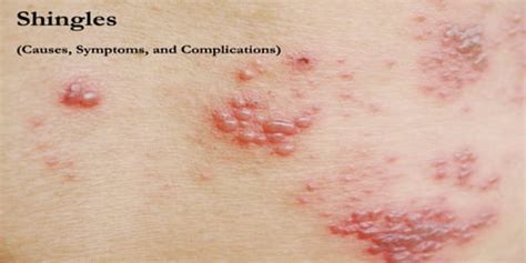 Shingles (Causes, Symptoms, and Complications) - Assignment Point