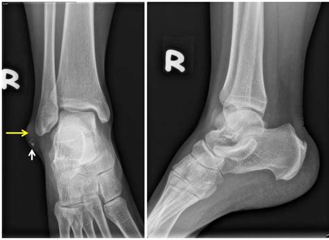 Epidermal cyst at ankle – Radiology Cases