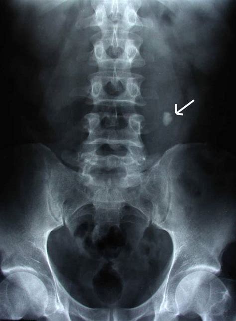 Calculi in left ureter lateral