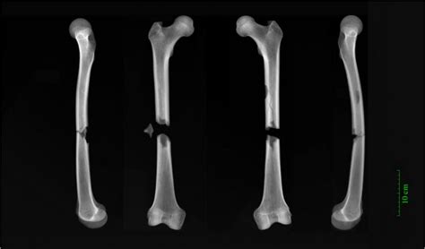 X-rays of femur fractures foun [IMAGE] | EurekAlert! Science News Releases