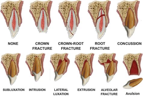 Treatment of an extensive radicular fracture: the pre-endodontic restoration of a structurally ...