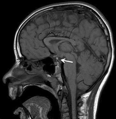 Pituitary: Pituitary Hypoplasia