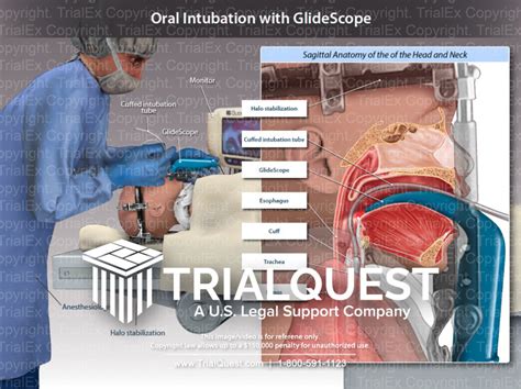 Oral Intubation with GlideScope - Trial Exhibits Inc.