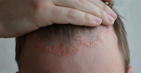 6 Foods You Should Avoid To Prevent Psoriasis Flare-Ups - CureJoy