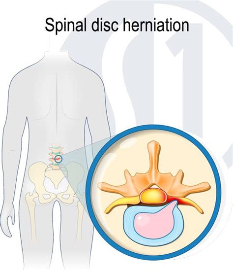 Disc Protrusion Treatment at Spine One | Denver Spine Pain Specialists