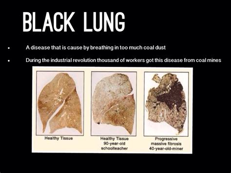 Black Lung Disease by Karina petrovich