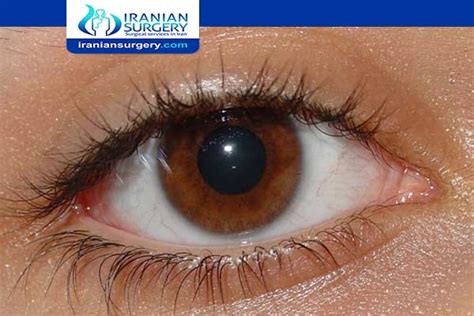 corneal scarring healing time | corneal scar recovery time | Iranian Surgery