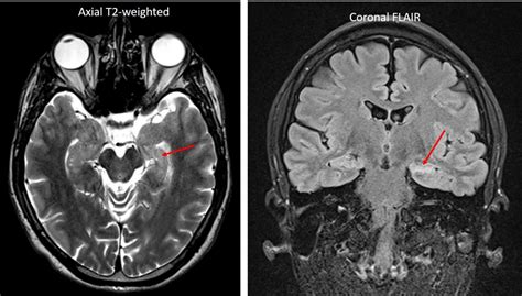 Mesial temporal sclerosis – Radiology Cases