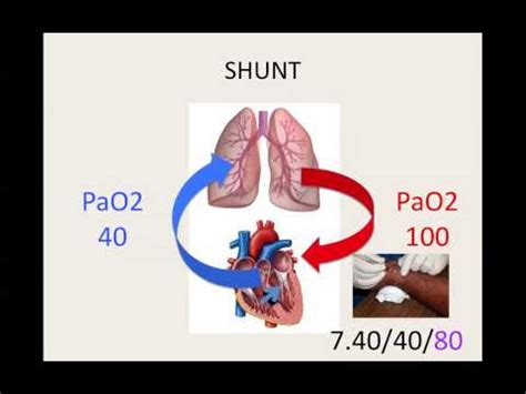 Pulmonary Shunt