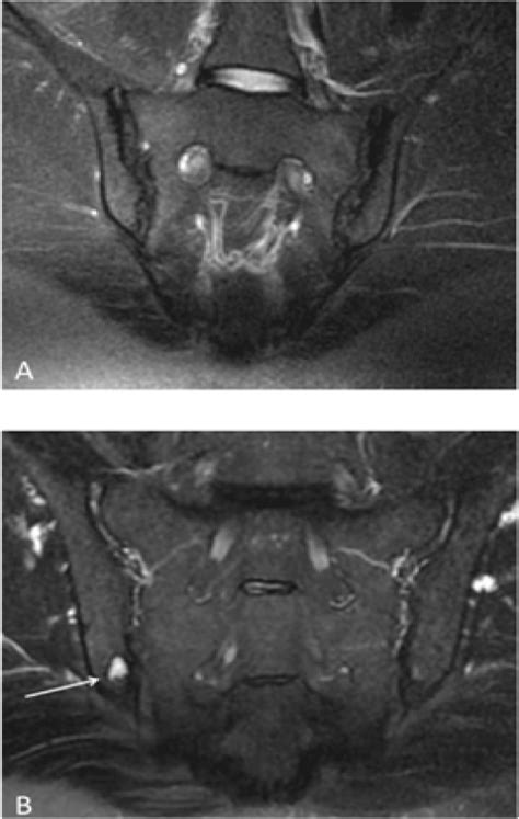 Sacroiliac Joint Erosion