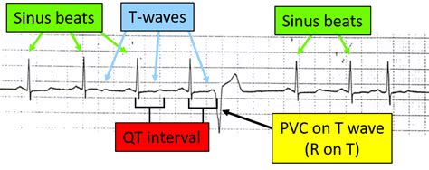 R on T Premature Ventricular Complexes (PVC) Simplified | ECGEDU.com