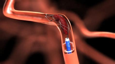 Neurovascular Devices Market to Grow at a CAGR of 7.6% during