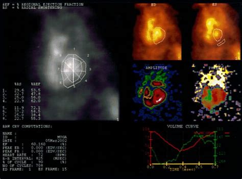 MUGA Scan - Hamilton Cardiology Associates - New Jersey's Leading Board Certified Cardiologists