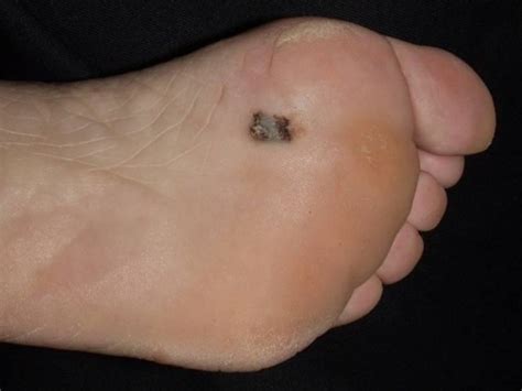 PODIATRISTS DIAGNOSING MELANOMA IN FEET