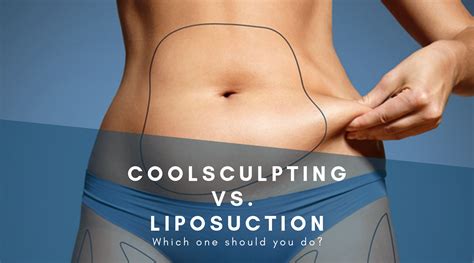 CoolSculpting™ vs. Liposuction