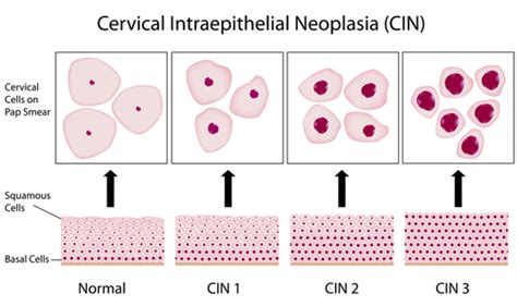 Treatment for Cervical Cancer | Total Health