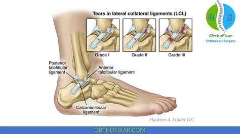 Ankle Sprain Grades